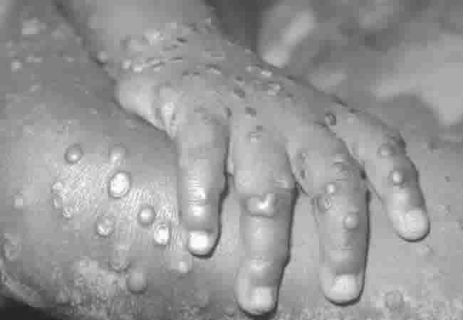 One Dies As Nigeria Records 41 Cases Of Monkeypox