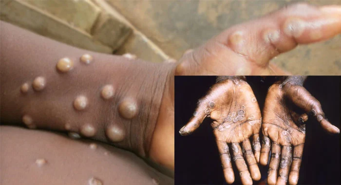 Monkeypox Can Be Transmitted Through Sex, Says NCDC